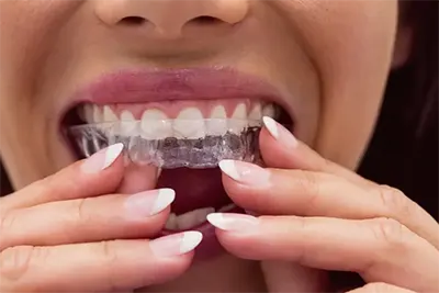 Aparelho Dentário em Guarulhos