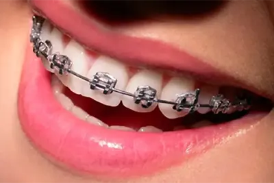 Aparelho Dentário em Guarulhos