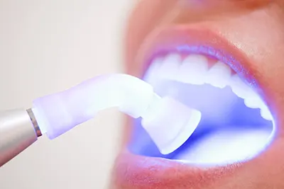 Clareamento de Dentes em Guarulhos