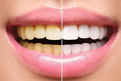 Clareamento de Dentes em Guarulhos