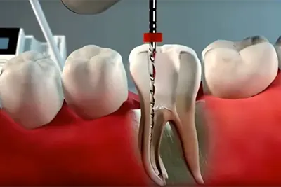 Endodontia em Guarulhos