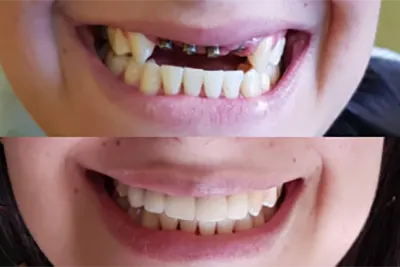 Implantes de Dentes em Guarulhos