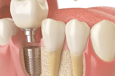 Implantes de Dentes em Guarulhos