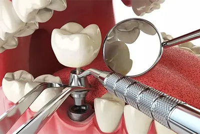 Implantes Dentários em Guarulhos
