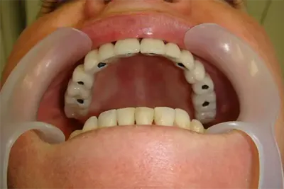 Implantes Dentários em Guarulhos