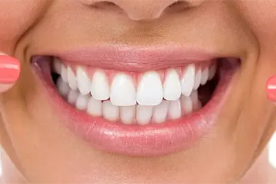 Lente de Contato Dental em Guarulhos