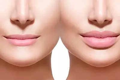 Preenchimento Labial em Guarulhos