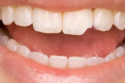 Restauração Dentária em Guarulhos