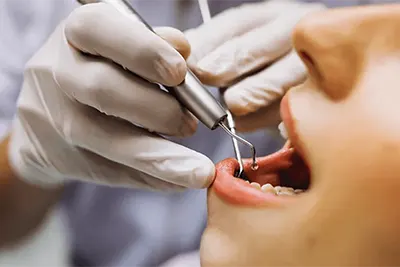 Tratamento de Endodontia em Guarulhos